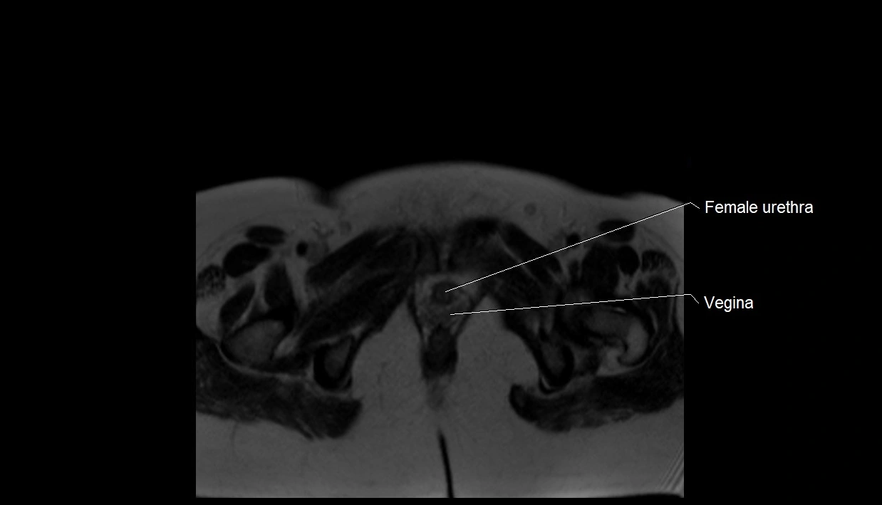 MRI fetal anatomy axial image 42.webp